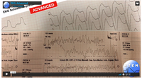 Video EKG Advanced