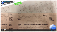 Video EKG Basics